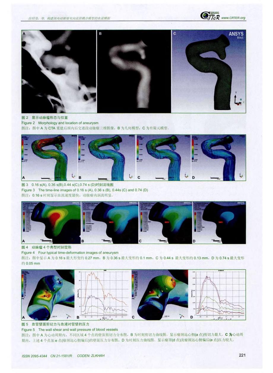构建颈内动脉瘤双向流固耦合模型的血流模拟_第4页