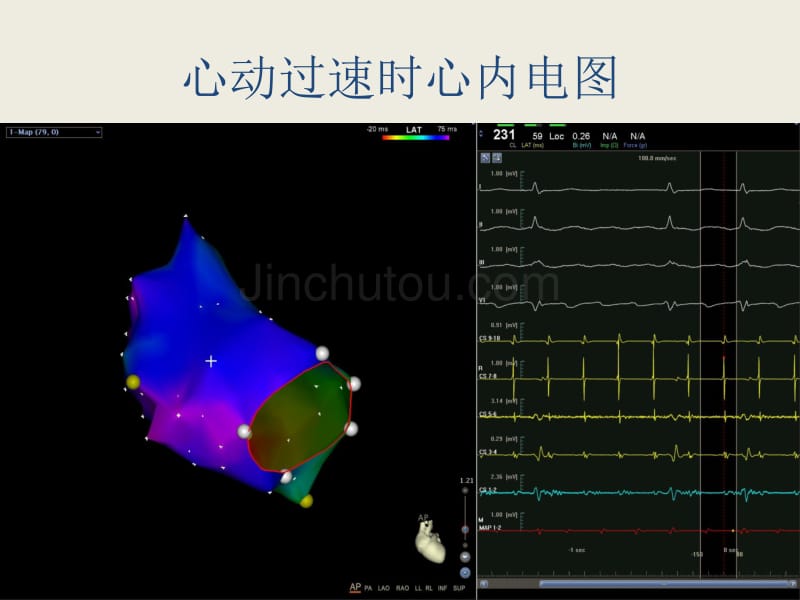 疤痕与否,确定房速消融线路的关键-谭琛01-24_第4页