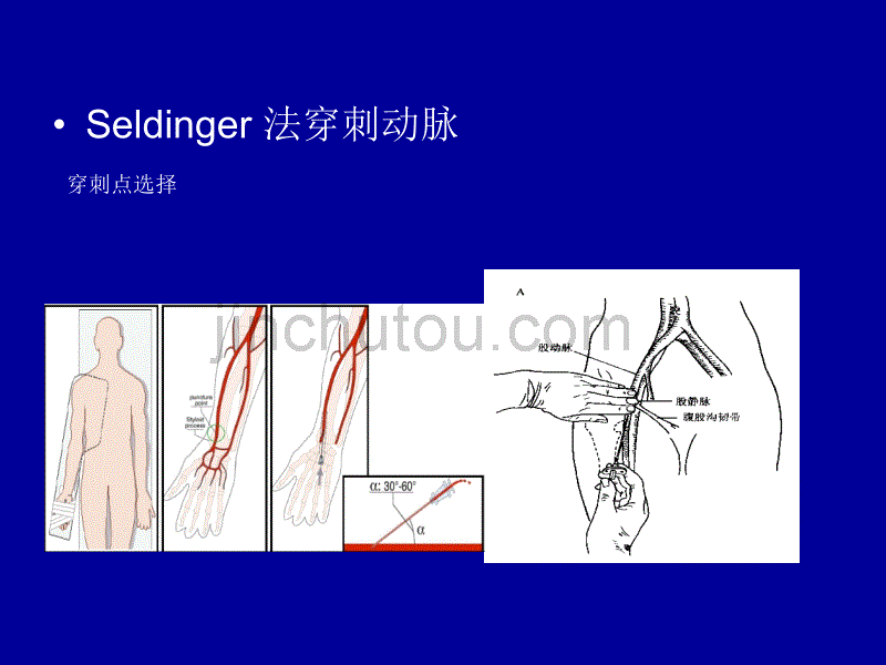 冠状动脉造影基本流程-jenkin_第3页