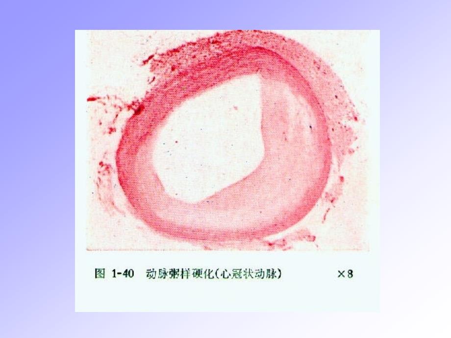 动脉粥样硬化医学课件_第3页