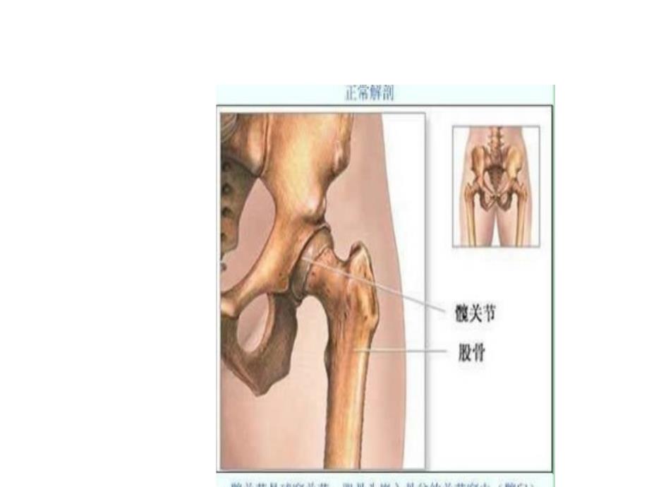 髋关节置换术ppt课件_第3页