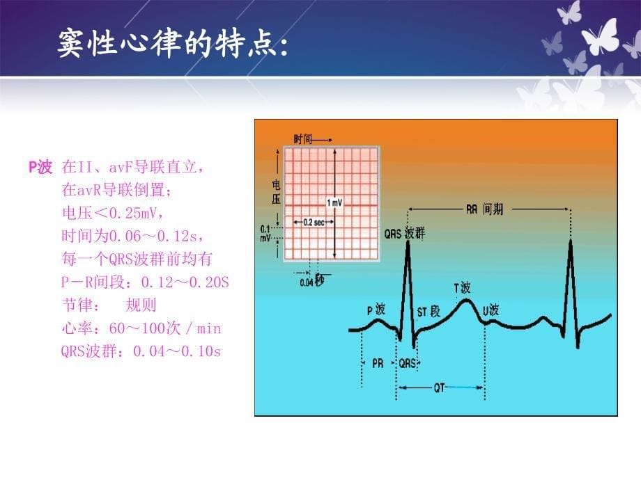 常见心律失常与急救护理_第5页