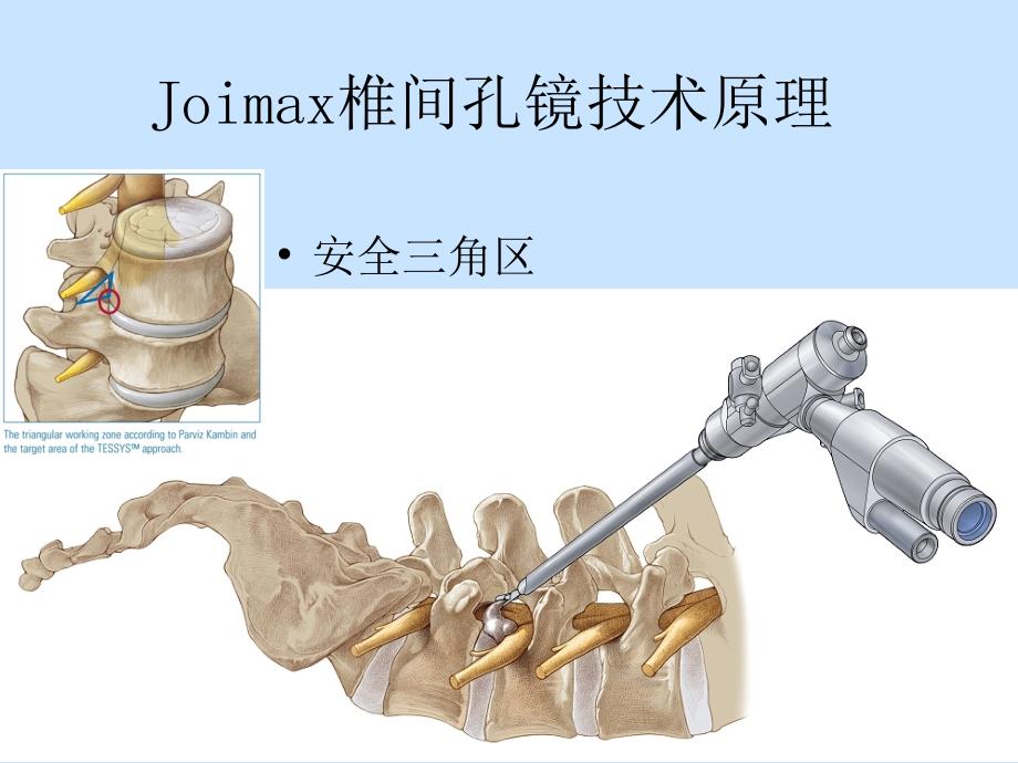 joimax椎间孔镜技术_第3页