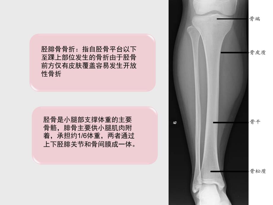 胫腓骨折病人护理查房_第4页