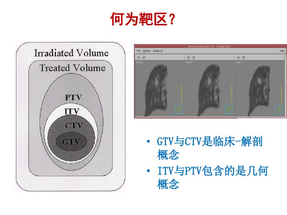 肺癌靶区勾画-肿瘤学基地讲课_第4页