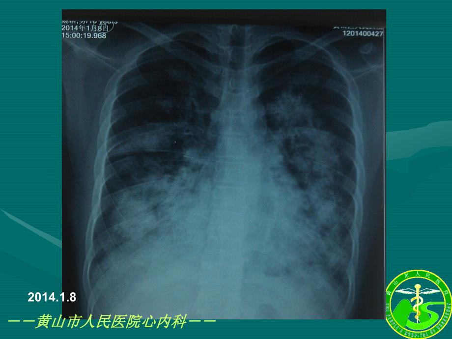 呼吸支持在急性心衰中应用_第3页