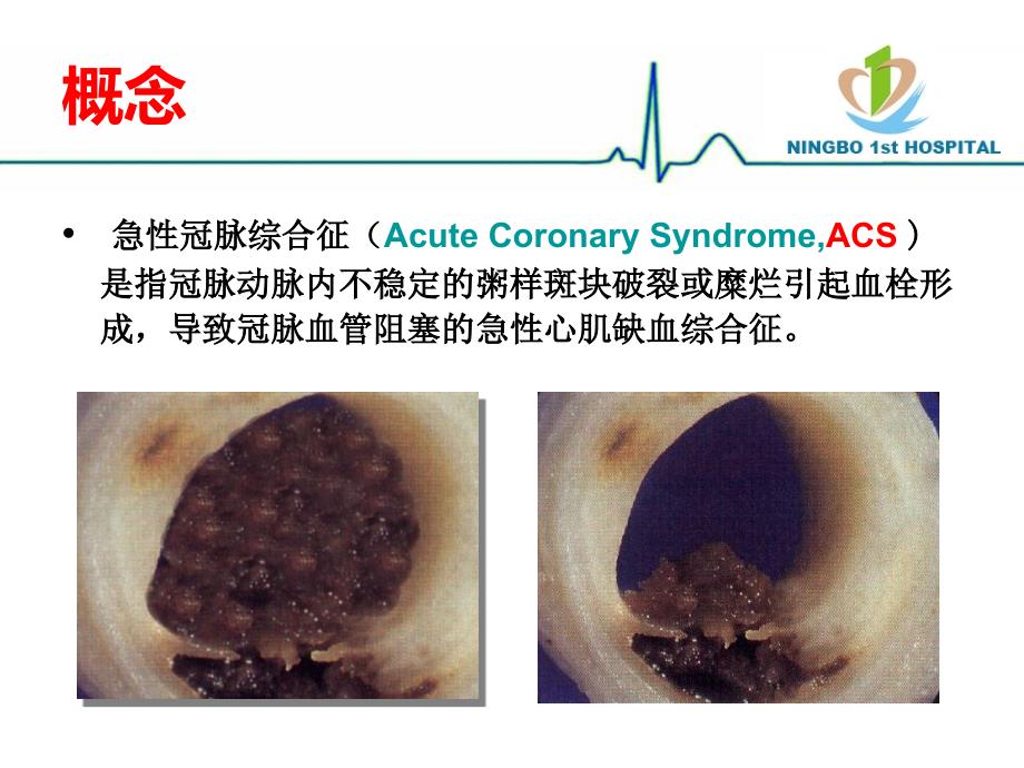 nste-acs危险分层及处理策略(_第2页