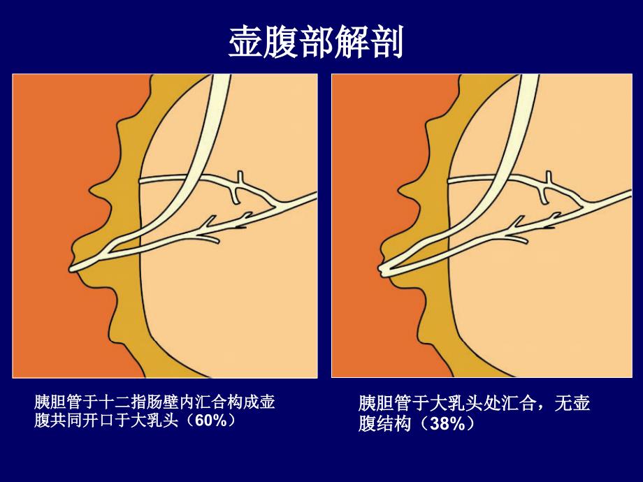 壶腹周围癌影像诊断最新2016.3.30_第3页