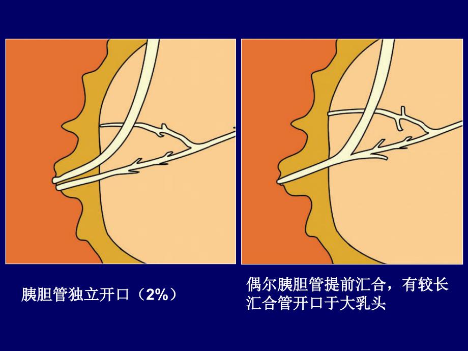 壶腹周围癌影像诊断最新2016.3.30_第4页