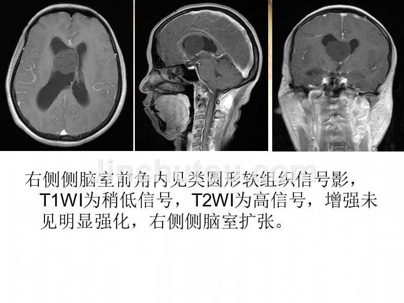 室管膜下瘤诊断与鉴别诊断_第4页