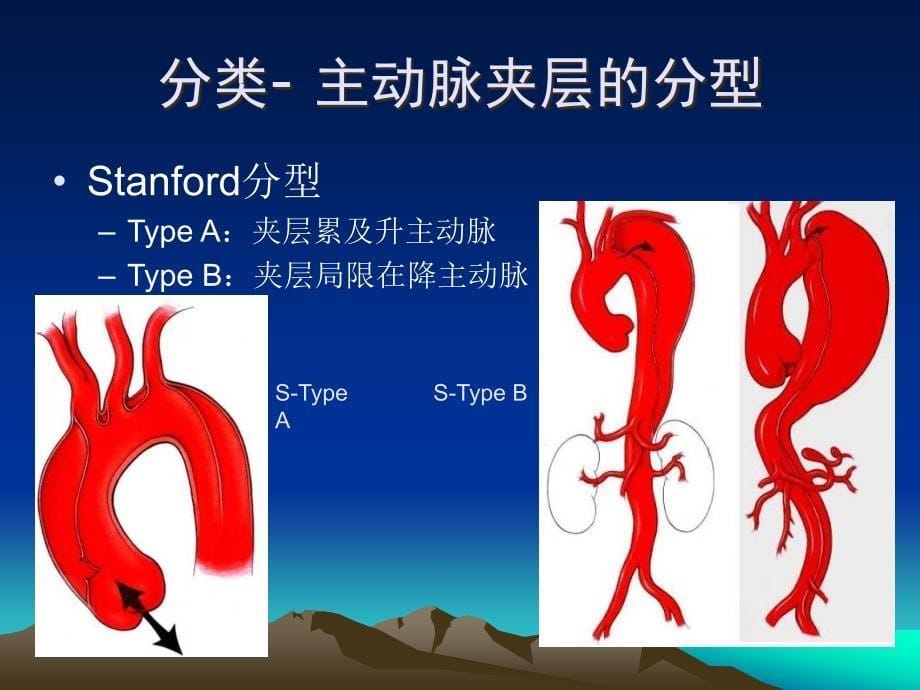 腔内隔绝术治疗Stanford_第5页