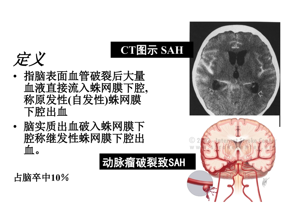 蛛网膜下腔出血.ppt_第2页