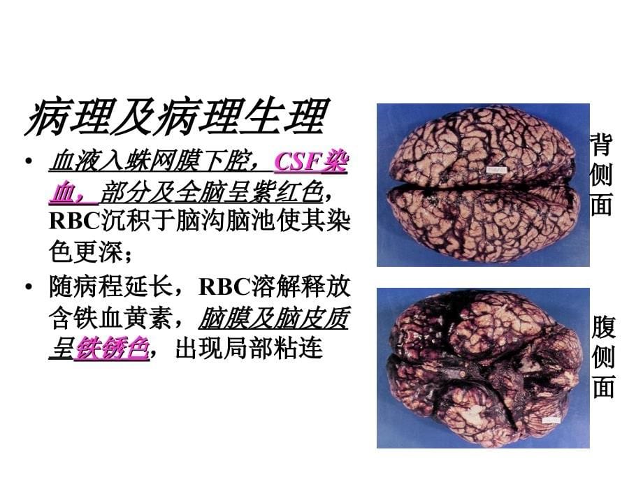 蛛网膜下腔出血.ppt_第5页