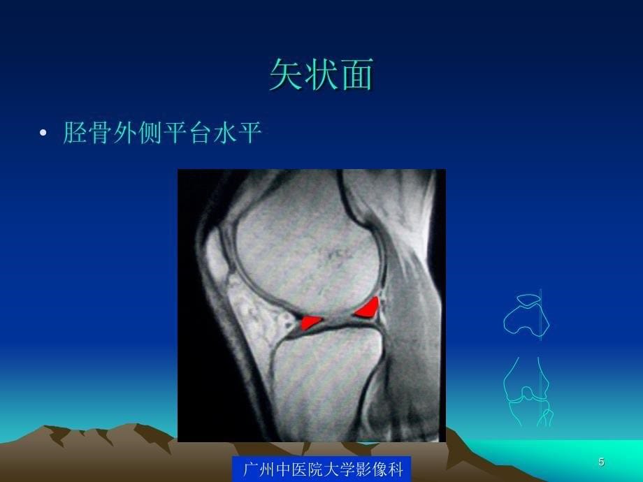 膝关节 损伤MR影像表现_第5页