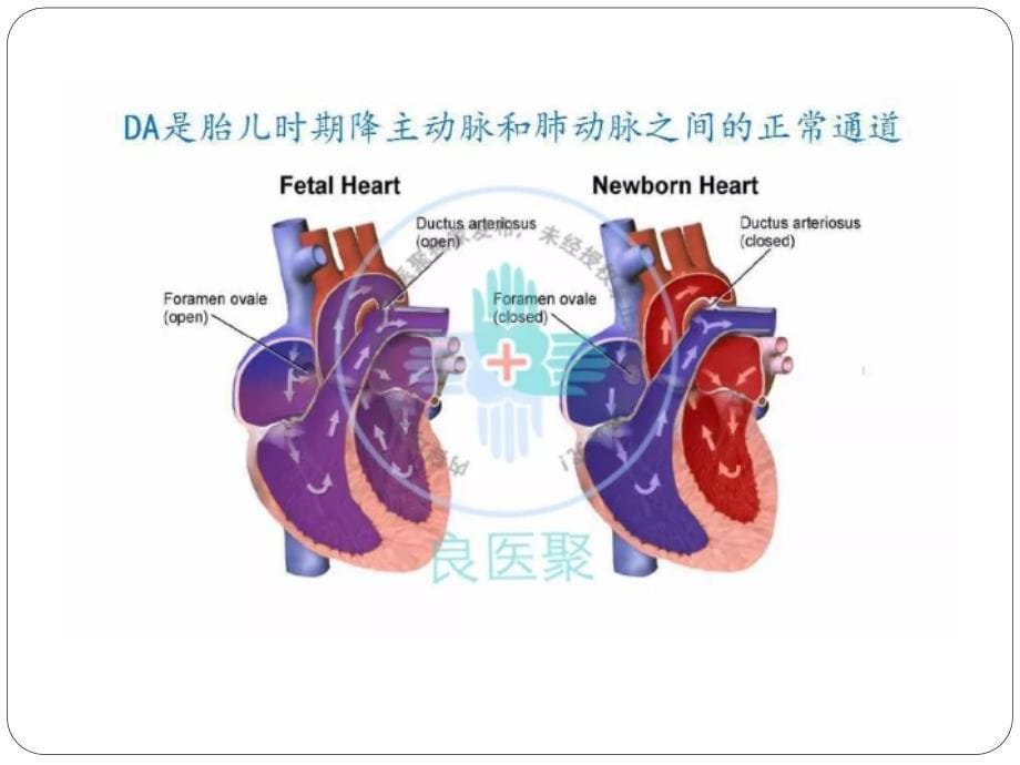 早产儿动脉导管未闭的管理_第5页