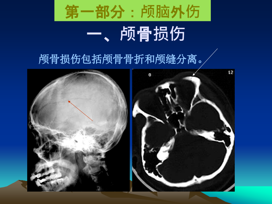 医学网站(医学百事通)-颅脑外伤和脑血管病变_第2页