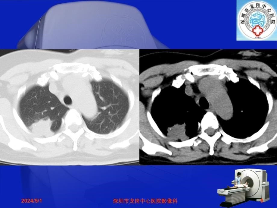 影像科经典读片之二：肺炎性假瘤影像诊断分析_第5页