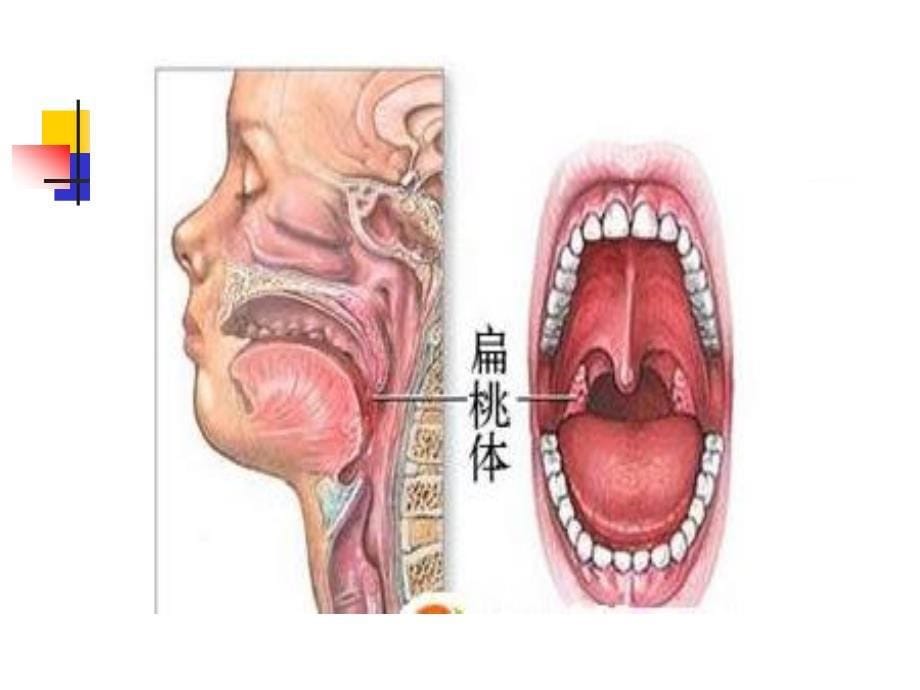 乔建君----腺样体和扁桃体炎几种外治疗法_第5页