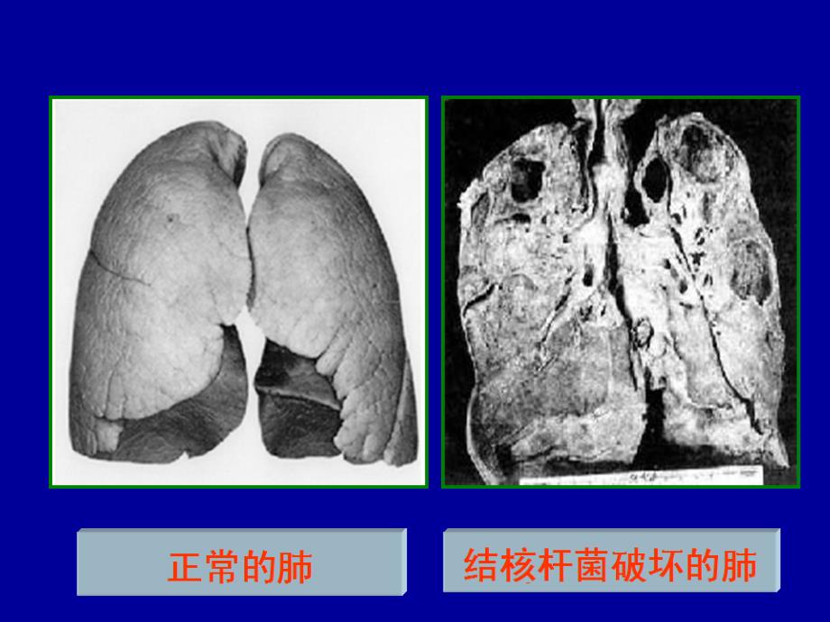 学校结核病防治知_第3页