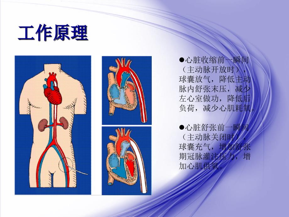 2018主动脉球囊反搏护理.ppt_第4页