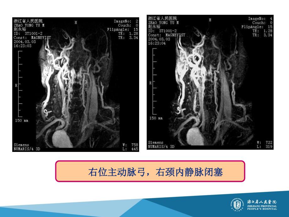 主动脉肺血管先天性病变影像诊断(袁建华)_第4页