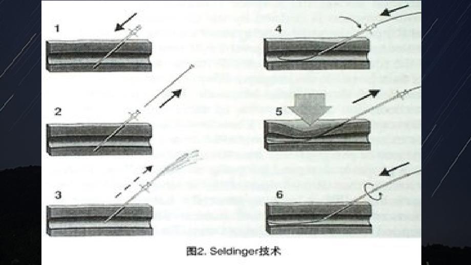 介入手术简介_第3页