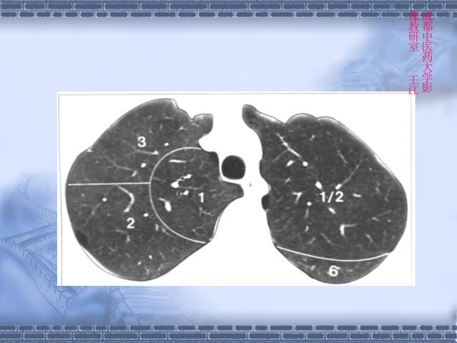 胸部肺窗肺叶肺段_第2页
