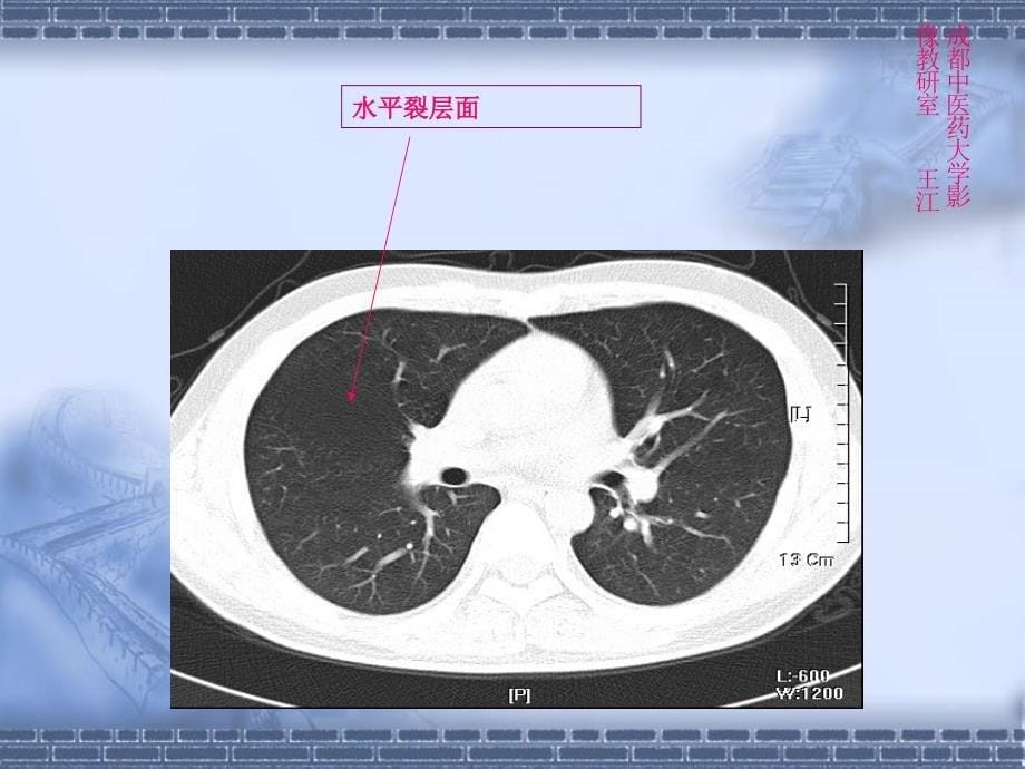 胸部肺窗肺叶肺段_第5页