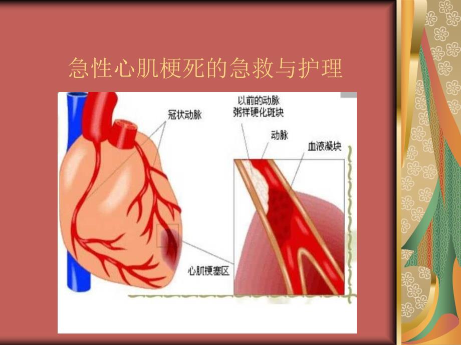 急性心肌梗死急救和护理_第1页