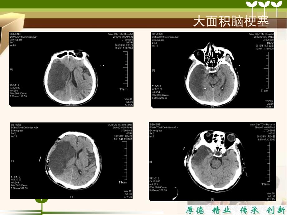 脑梗塞病人治疗护理要点_第3页