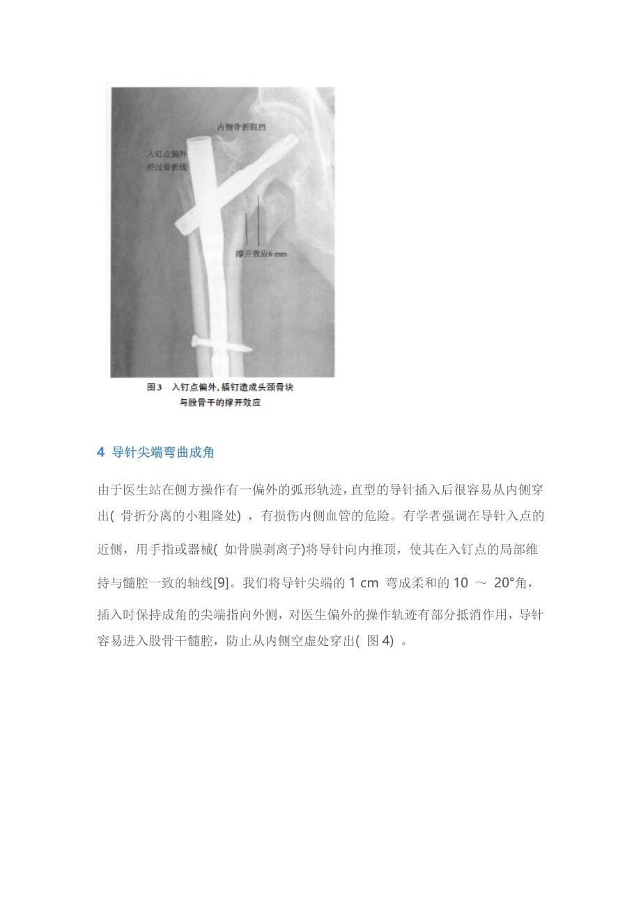 老年股骨粗隆间骨折pfna-ⅱ插钉内固定的手术技巧_第5页