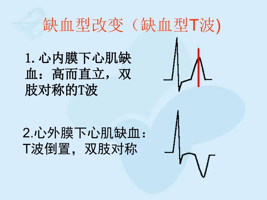 心肌梗死心电图改变_第4页