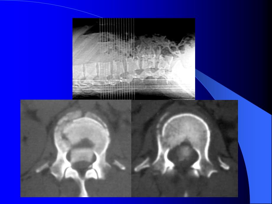 脊柱结核 转移瘤  骨折诊断与鉴别诊断_第4页