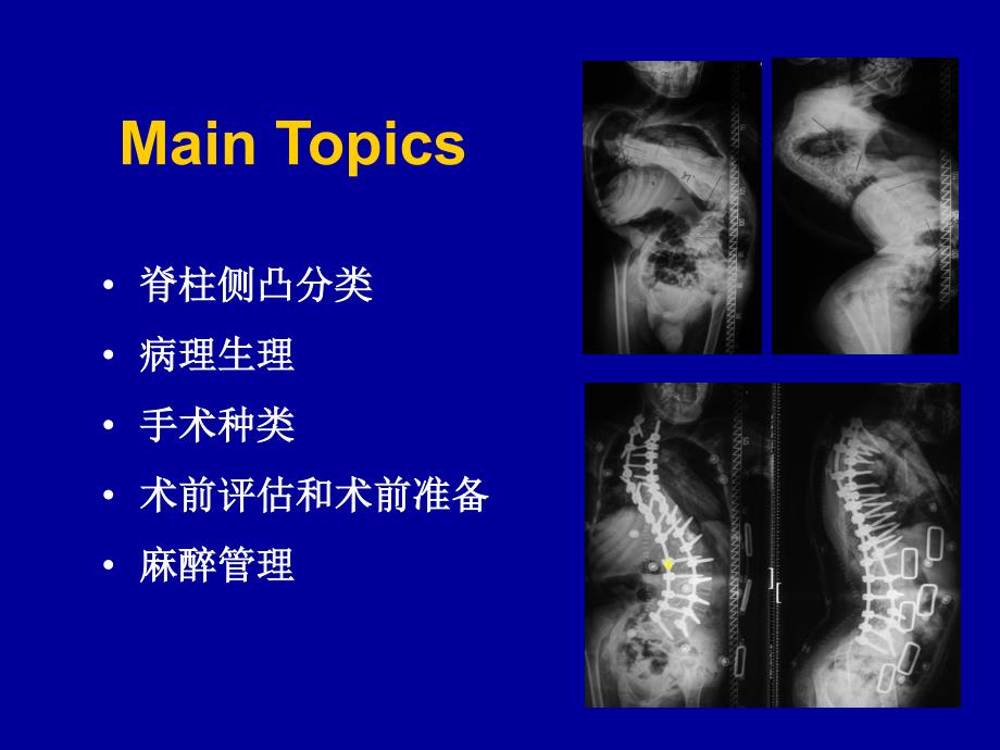 脊柱侧凸手术围术期管理_第3页