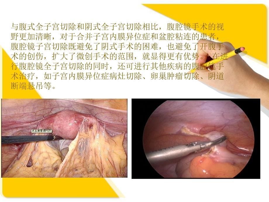 腹腔镜辅助下阴式全子宫切除术手术护理查房_第5页