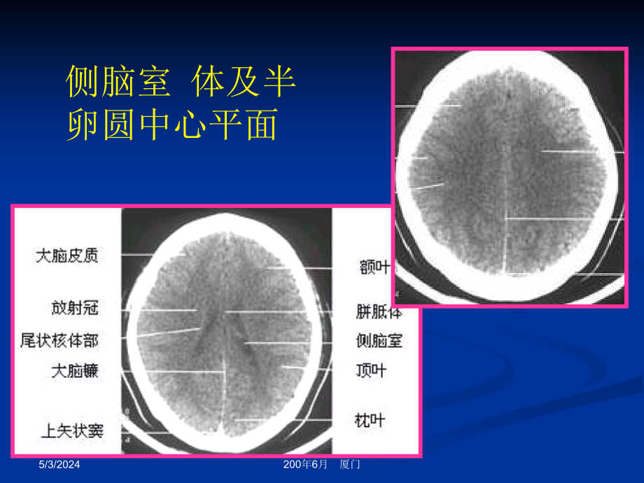 神经系统解剖与常见疾病ctmri表现_第4页