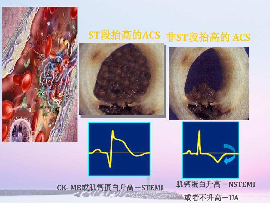 急性冠脉综合征护理ppt_第4页