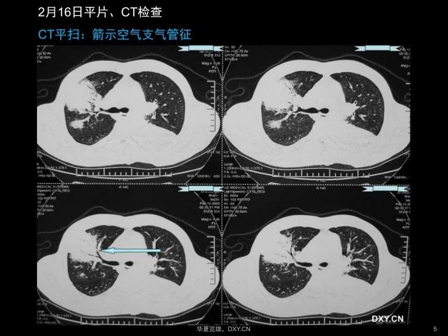 炎症、结核、肿瘤在ct及胸片上的区别--图文_第5页