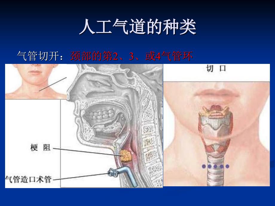 icu患者人工气道护理要点_第4页