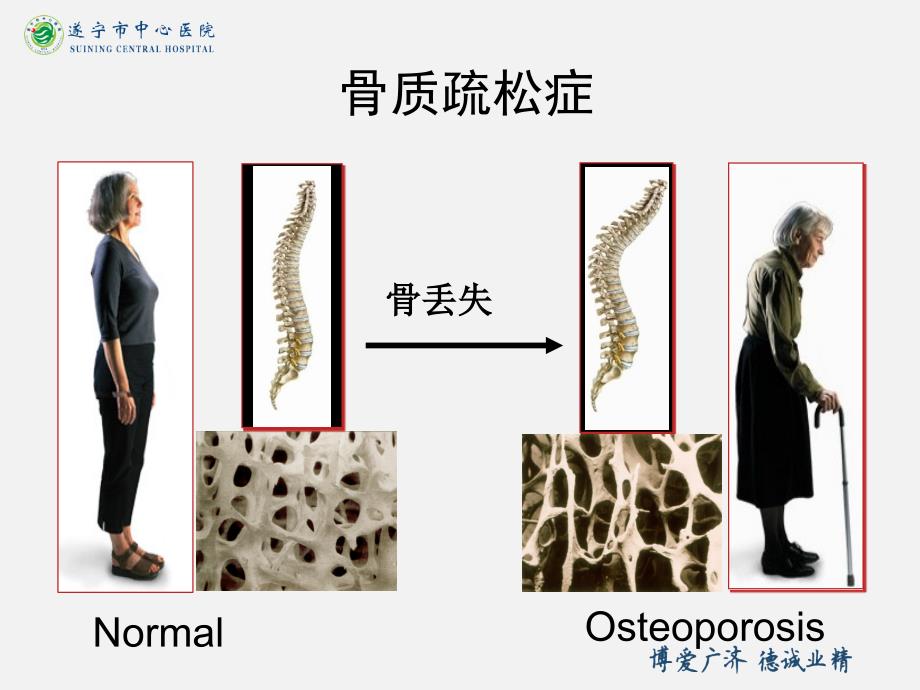 骨质疏松性椎体压缩性骨折_第4页