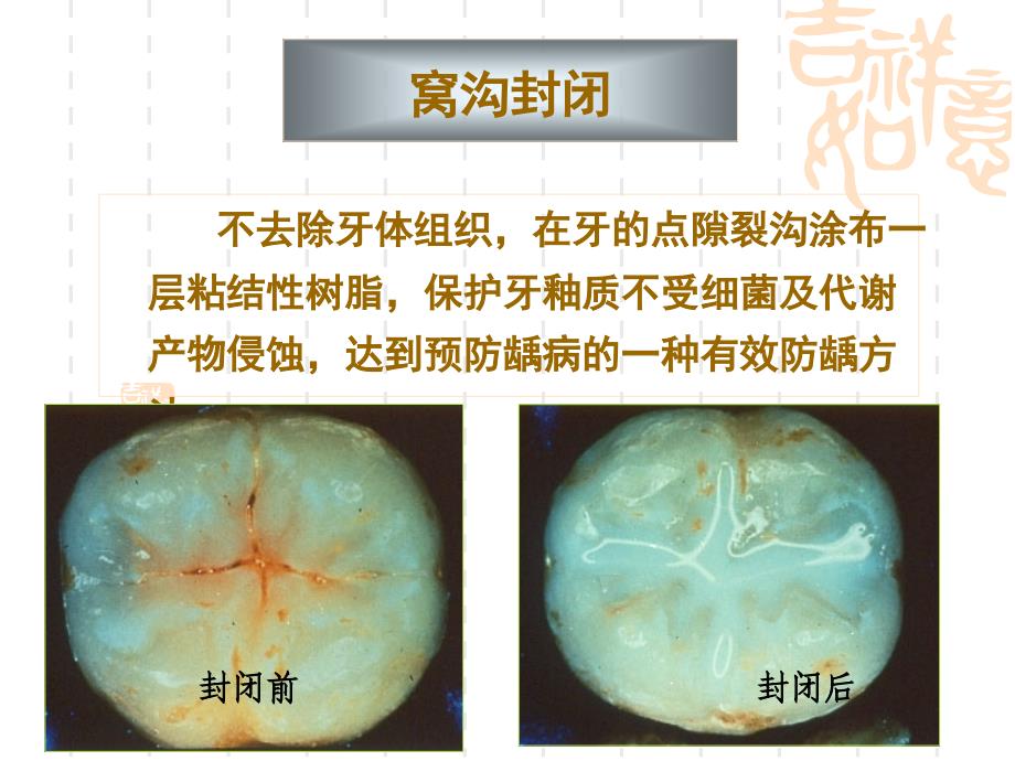 窝沟封闭_第3页