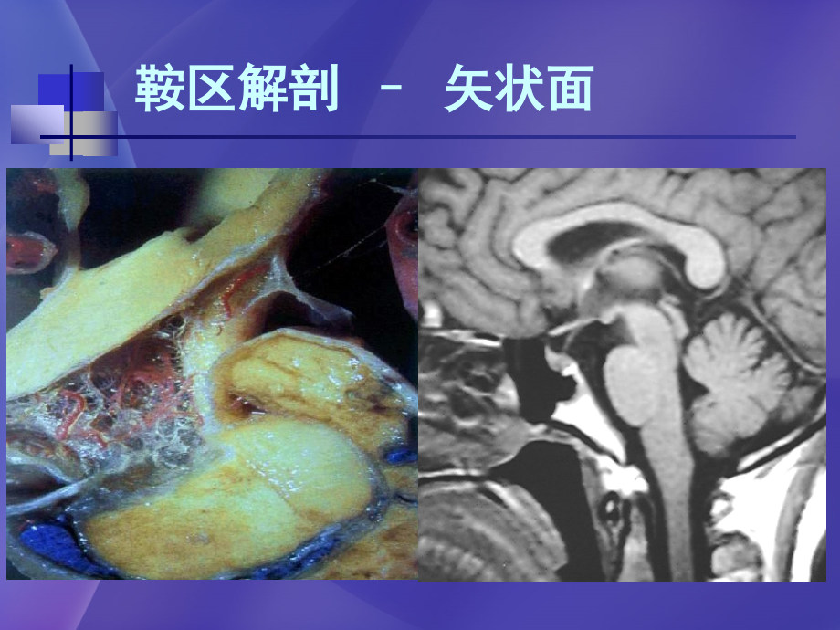 儿童鞍区常见肿瘤影像学诊断--高培毅_第4页