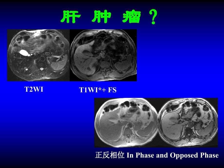 叶慧义-含脂质脂肪肝脏病变mri表现与诊断_第5页