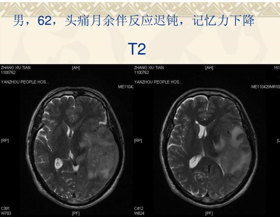dwi在颅脑疾病诊断中应用(下)_第5页