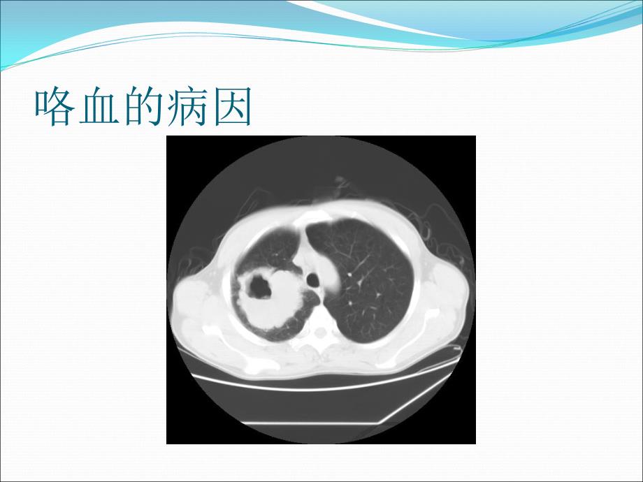 咯血诊断和治疗_第4页