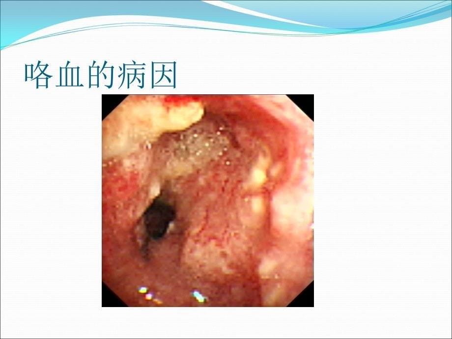 咯血诊断和治疗_第5页