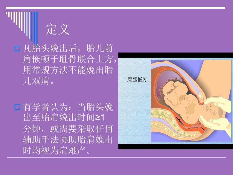 肩难产紧急处理课件_第3页