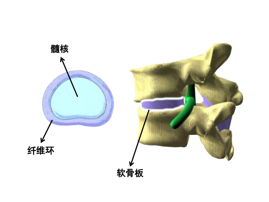 椎间盘突出症介入治疗常见并发症及其处理_第3页