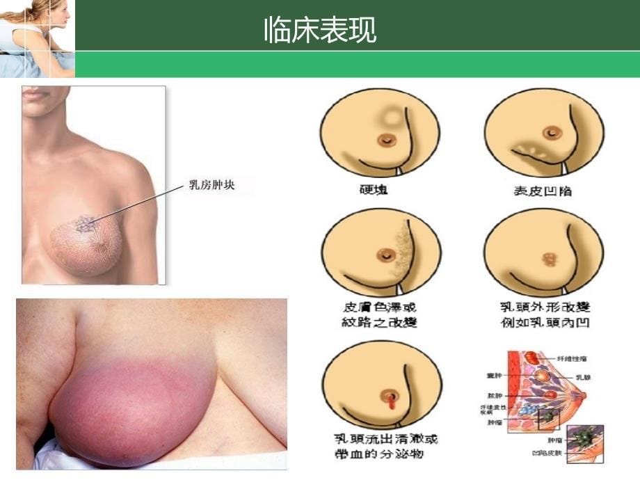 小组--乳腺癌健康宣教_第5页