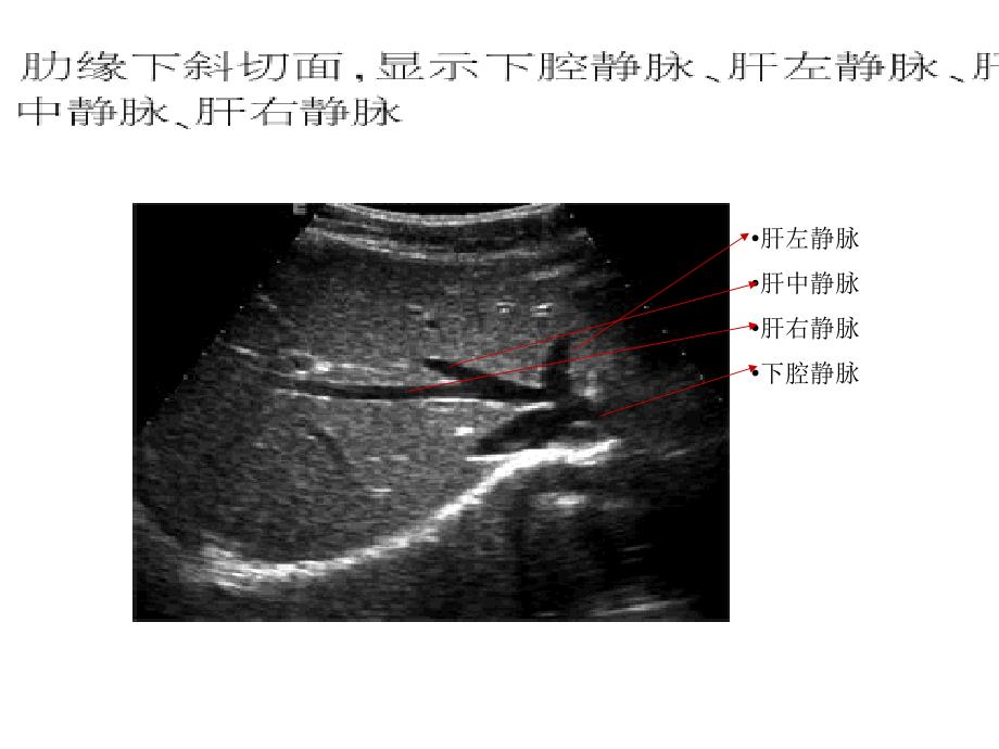 肝胆超声解剖培训_第3页